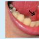 Рак порожнини рота - як діагностувати, лікувати і запобігти появі злоякісного новоутворення